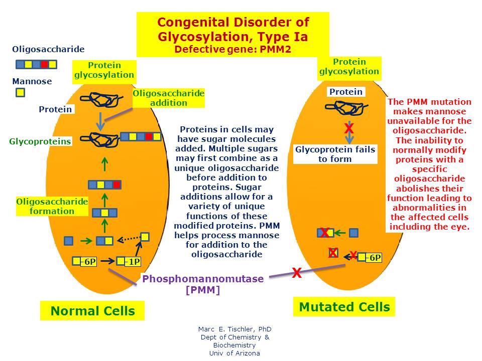 Congenital Disorder Of Glycosylation Type Ia Hereditary Ocular Diseases image-radiopaedia